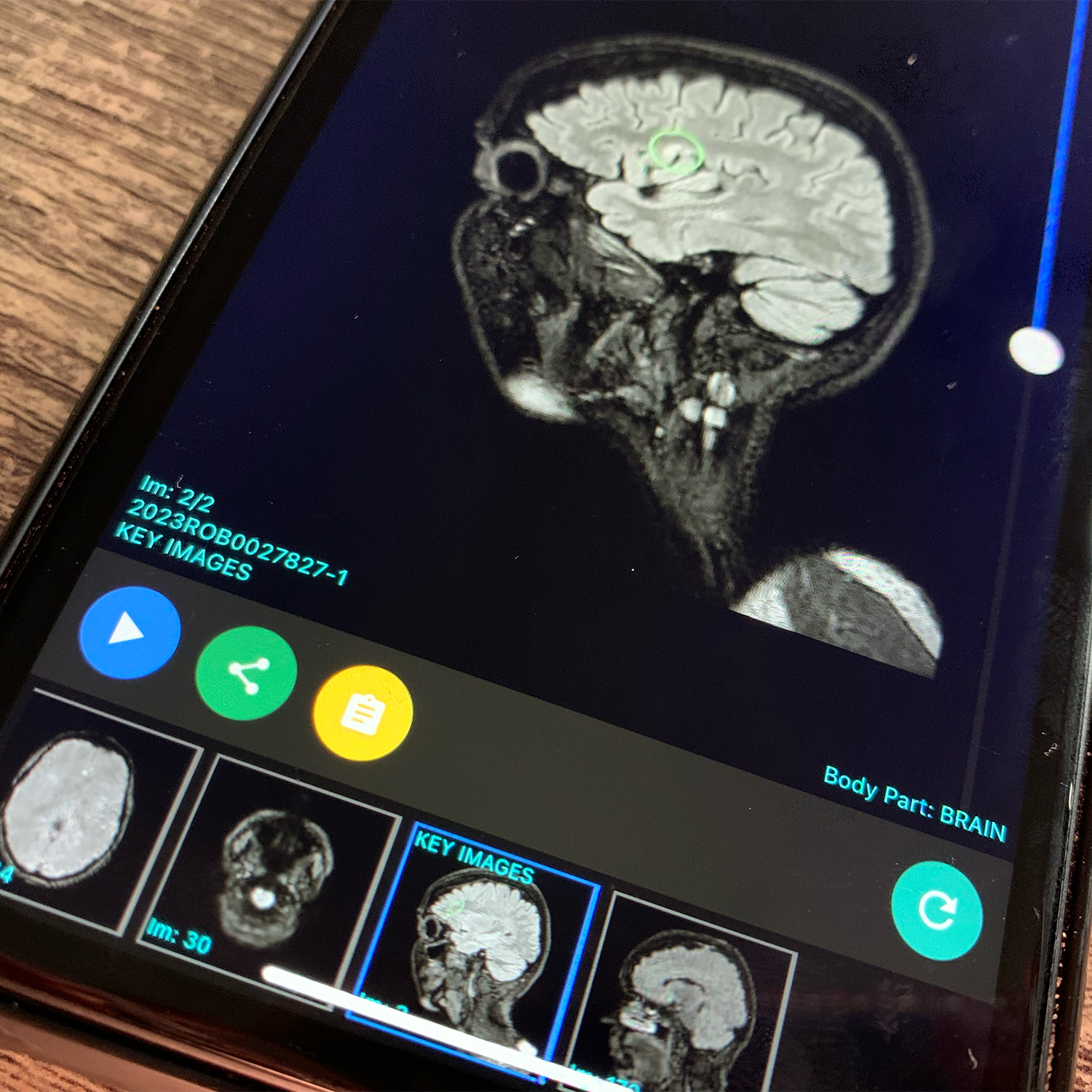 White matter disease workkidssleep